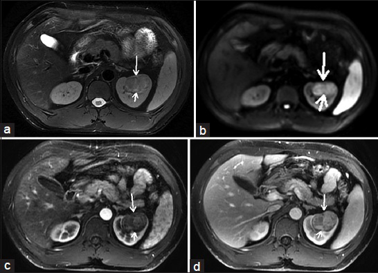 28-year-old man with Grade 3 hypertension for 7 years with a solid tumor on the left kidney and the pathological diagnosis was juxtaglomerular cell tumor after surgery. (a) On T2-weighted image, the lesion (short arrow) shows isointensity to mild hyperintensity with a low-signal capsule (long arrow). (b) On diffusion-weighted image, the lesion (short arrow) indicates heterogeneous hyperintensity compared with the cortex signal and the low-signal capsule (long arrow) does not indicate clearly. (c) On the corticomedullary phase image, the lesion (short arrow) shows mild enhancement. (d) On the nephrographic phase image, the lesion (short arrow) shows a mild persistent enhancement.