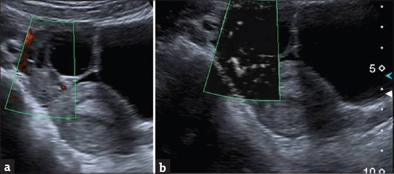 A 16-year-old previously healthy girl presented with right lower abdominal pain and vomiting of 10 h duration. (a) Power Doppler of ovary shows no flow and (b) using Doppler superb microvascular imaging the flow is clearly seen rolling out torsion of ovary.