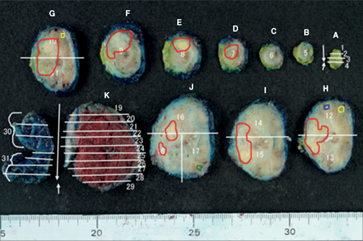 Pathological map of PC. (A-K and 1-31 are specimen identification codes. The white line is the excision line of the specimen. Four PC lesions detected on the pathological map of PC are illustrated in red, yellow, blue, and green.) (PC: Prostate cancer.)